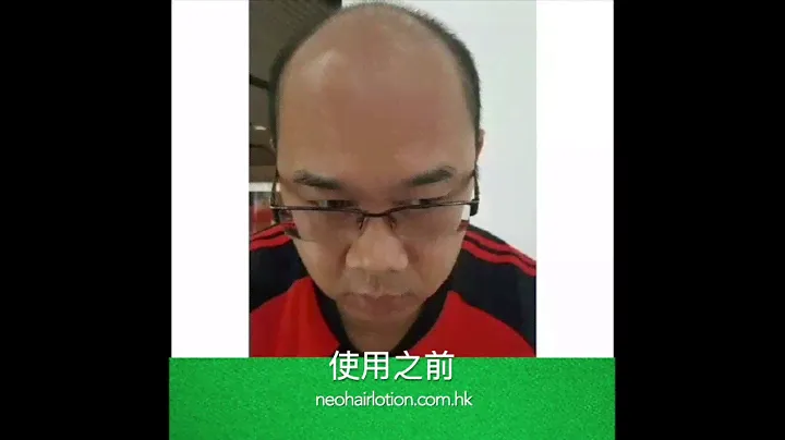 Neo Hair Lotion 生髮精華素 真實見證 真正有效!