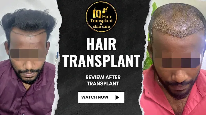 Honest Hair Transplant Patient Review, IQ HAIR TRANSPLANT AND SKIN CARE CLINIC, Chennai, Pallavaram.