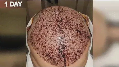 FUE Hair Transplant Timeline I Day 1 to Day 365