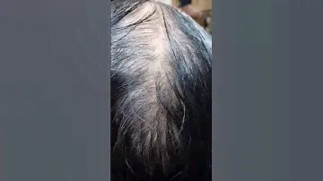 Ampollas anticaída de cabello #cabellosano #cabellofuerte #cabellolargo #cabellobrillante #cabello