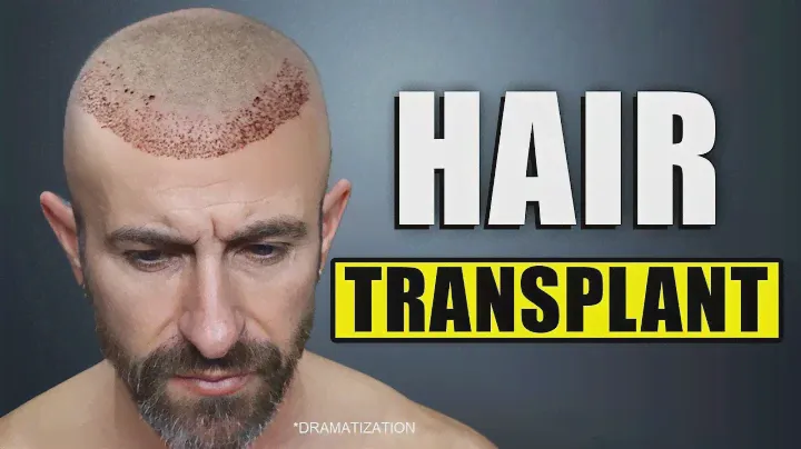 I Went to Bosley for a Hair Transplant
